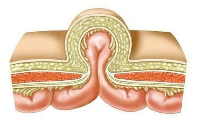疝气的病因介绍